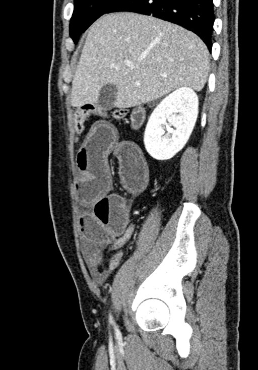 Adhesional small bowel obstruction (Radiopaedia 58900-66131 Sagittal C+ portal venous phase 68).jpg