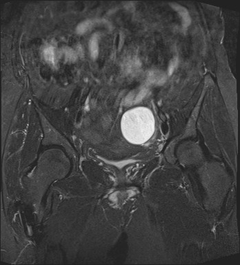 File:Adnexal multilocular cyst (O-RADS US 3- O-RADS MRI 3) (Radiopaedia 87426-103754 Coronal T2 fat sat 14).jpg
