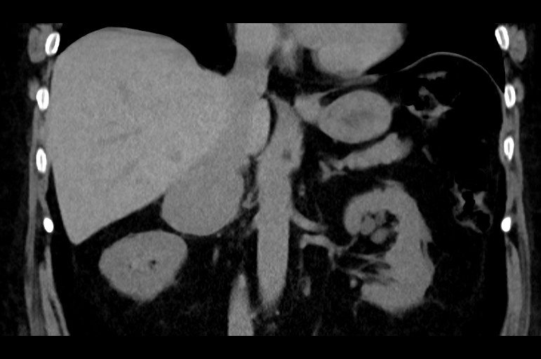 Adrenal cortical carcinoma (Radiopaedia 64017-72769 Coronal non-contrast 31).jpg