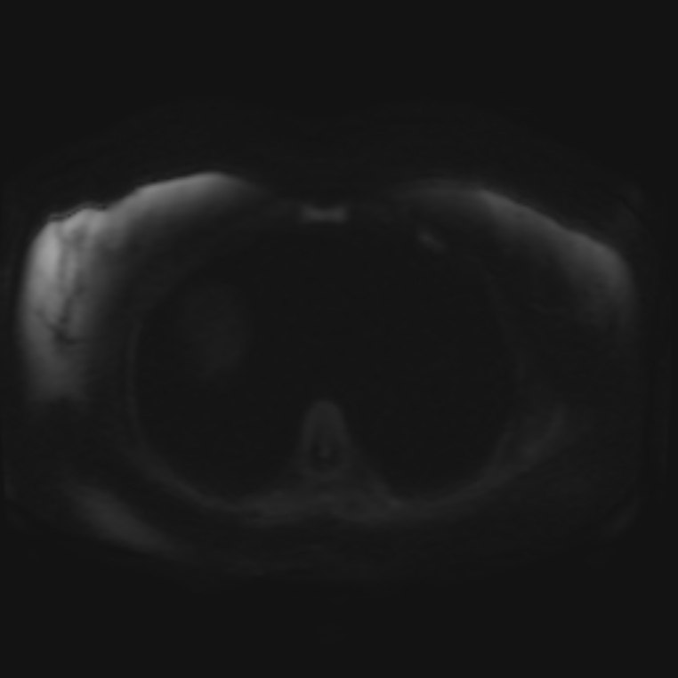 Adrenal cortical carcinoma (Radiopaedia 70906-81116 Axial DWI 28).jpg