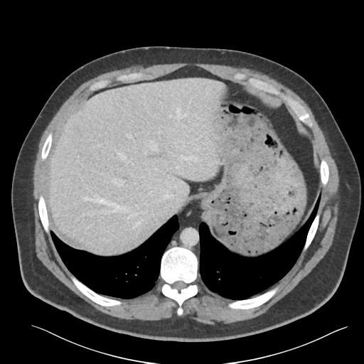 File:Adrenal cyst (Radiopaedia 45625-49777 Axial C+ portal venous phase 22).png