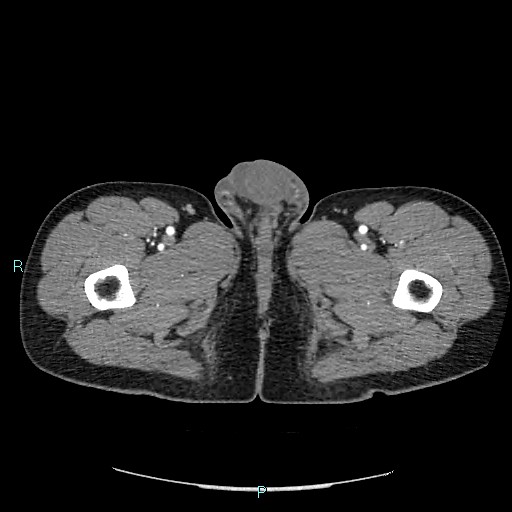File:Adrenal cystic lymphangioma (Radiopaedia 83161-97534 Axial C+ arterial phase 114).jpg