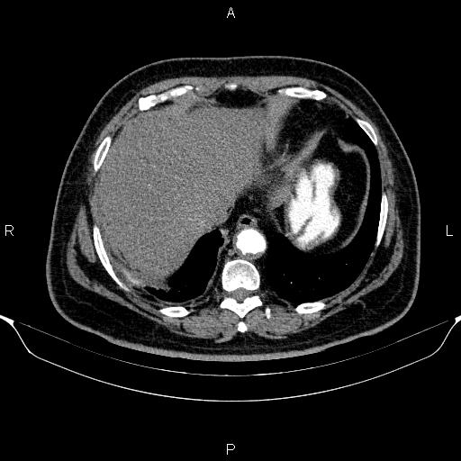 Adrenal hemorrhage (Radiopaedia 62622-70916 Axial C+ arterial phase 36).jpg