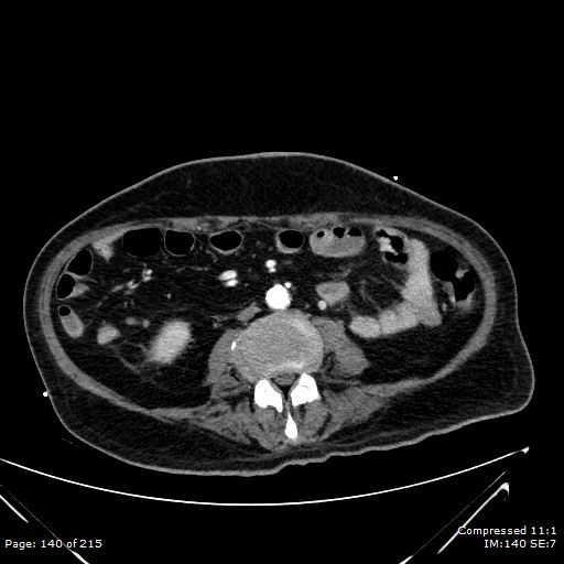 Adrenal metastasis (Radiopaedia 78425-91079 Axial C+ arterial phase 70).jpg