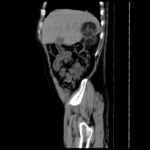 File:Adrenal myelolipoma (Radiopaedia 41843-44834 Sagittal non-contrast 2).jpg
