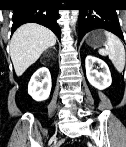 File:Adrenal myelolipoma (Radiopaedia 82742-96986 Coronal renal cortical phase 52).jpg