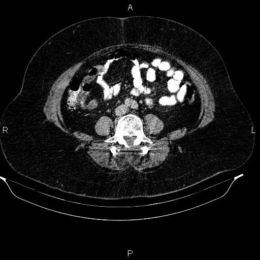 Adrenal myelolipoma (Radiopaedia 84319-99617 Axial renal cortical phase 70).jpg