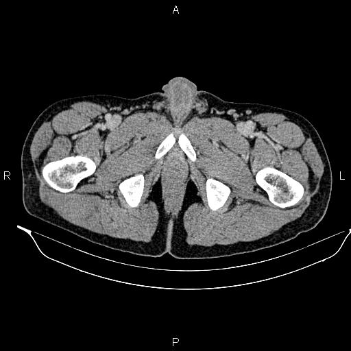 Adrenal myelolipoma (Radiopaedia 87794-104246 Axial renal cortical phase 114).jpg