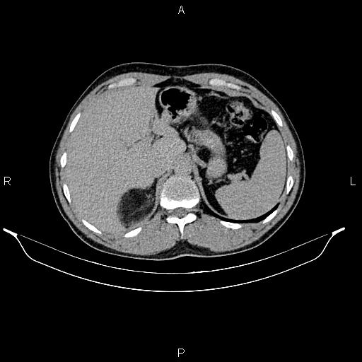 Adrenal myelolipoma (Radiopaedia 87794-104246 Axial renal excretory phase 22).jpg