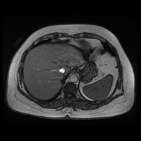 File:Adrenal myelolipoma - MRI (Radiopaedia 83249-97646 T1 out-of-phase 1).jpg