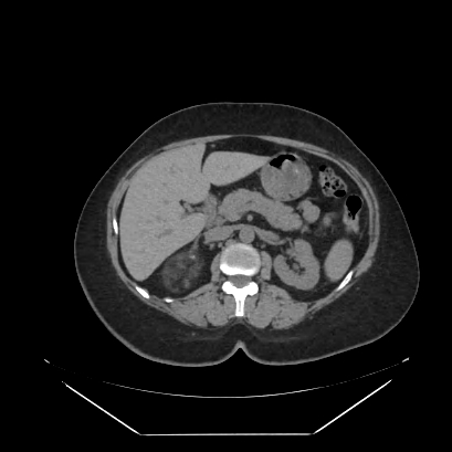 File:Adrenal myelolipoma - MRI (Radiopaedia 83249-97647 Axial non-contrast 44).jpg
