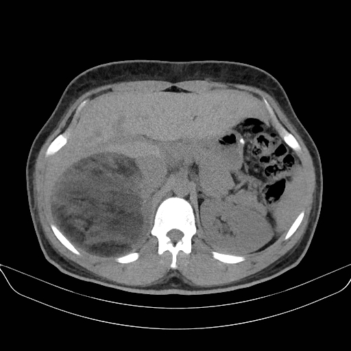 File:Adrenal myelolipoma - bilateral (Radiopaedia 74805-85810 Axial non-contrast 21).jpg