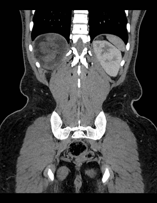 Adrenal myelolipoma - bilateral (Radiopaedia 74805-85810 Coronal C+ portal venous phase 82).jpg