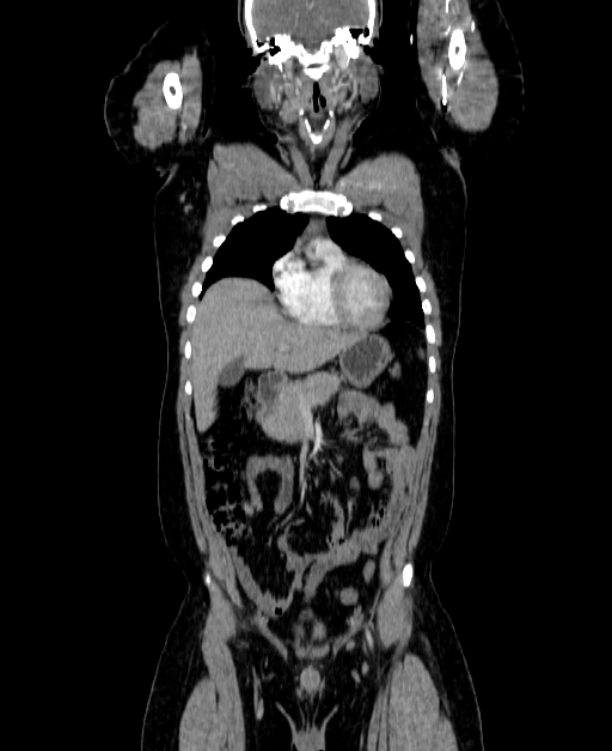 Adrenocortical carcinoma (Radiopaedia 80134-93438 Coronal C+ portal venous phase 57).jpg