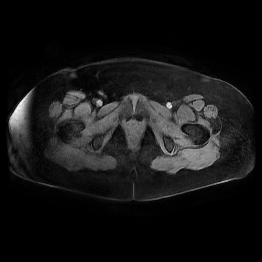 File:Adult granulosa cell tumor of the ovary (Radiopaedia 64991-73953 axial-T1 Fat sat post-contrast dynamic 16).jpg
