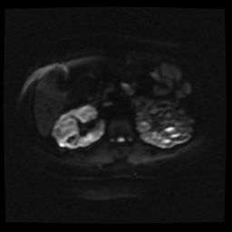 Adult polycystic kidney disease (Radiopaedia 59075-66365 Axial DWI 21).jpg