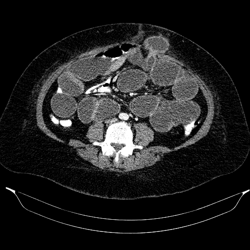 File:Afferent loop syndrome - secondary to incarcerated trocar site hernia (Radiopaedia 82959-97305 Axial C+ portal venous phase 143).jpg