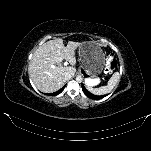 File:Afferent loop syndrome - secondary to incarcerated trocar site hernia (Radiopaedia 82959-97305 Axial C+ portal venous phase 54).jpg