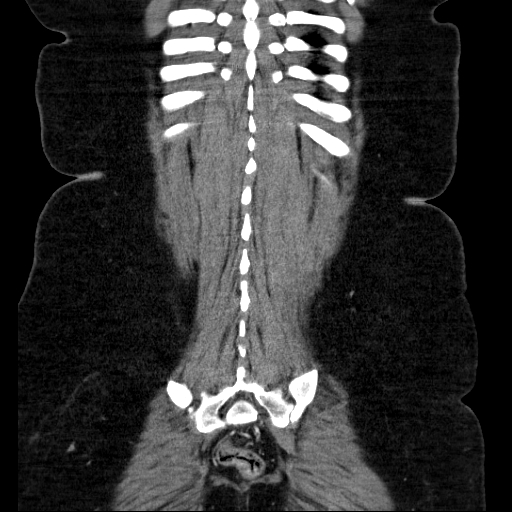 File:Afferent loop syndrome - secondary to incarcerated trocar site hernia (Radiopaedia 82959-97305 Coronal C+ portal venous phase 124).jpg