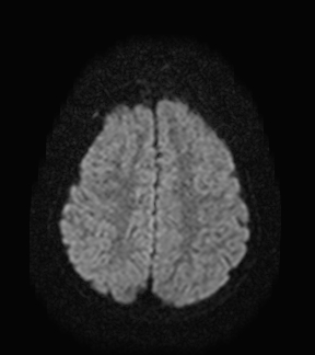 File:Aicardi syndrome (Radiopaedia 66029-75205 Axial DWI 17).jpg