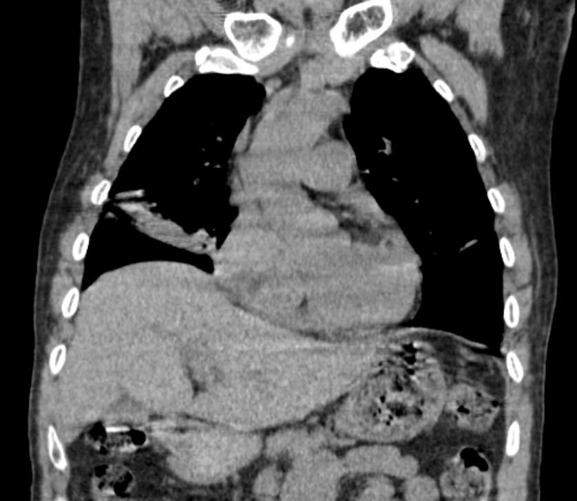Airway foreign body in adult (Radiopaedia 85907-101779 Coronal liver window 92).jpg