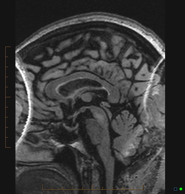 Aliasing artifact causing a spurious cerebellar lesion (Radiopaedia 48783-53810 Sagittal FLAIR 44).jpg