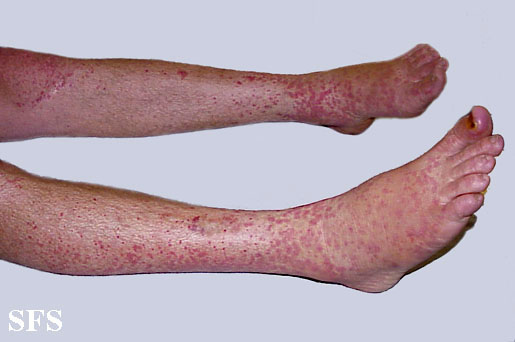 Allergic Vasculitis (Dermatology Atlas 1).jpg