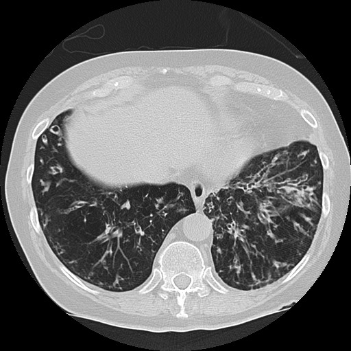 Alpha-1-antitrypsin deficiency (Radiopaedia 72058-82557 Axial lung window 57).jpg