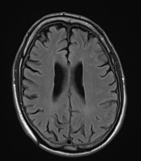 File:Alzheimer's disease- with apraxia (Radiopaedia 54763-61011 Axial FLAIR 18).png