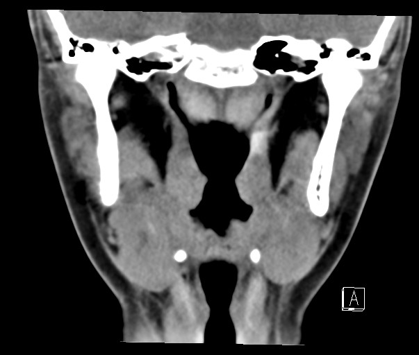 File:Ameloblastoma (Radiopaedia 26645-26793 Coronal C+ delayed 13).jpg