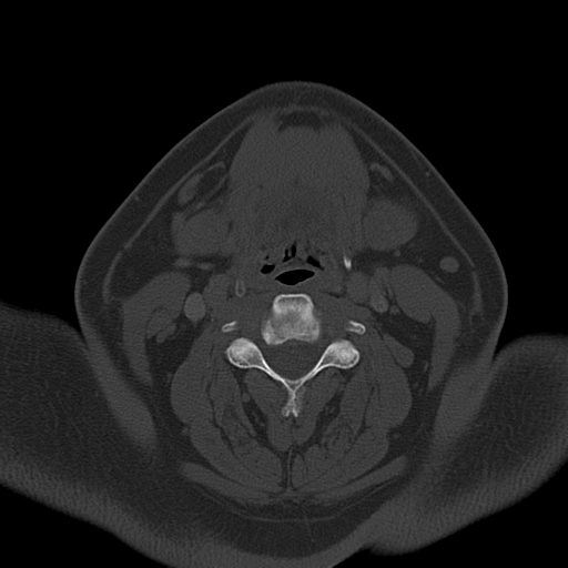 Ameloblastoma (Radiopaedia 38520-40623 Axial bone window 41).png