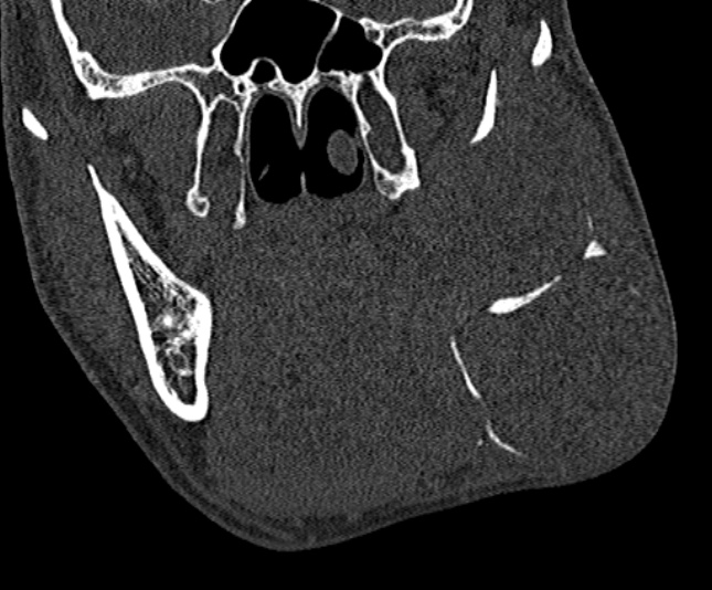 Ameloblastoma (Radiopaedia 51921-57766 Coronal bone window 124).jpg