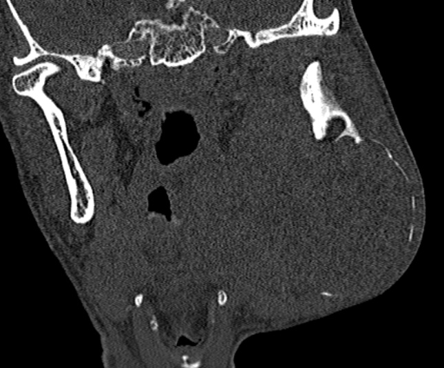Ameloblastoma (Radiopaedia 51921-57766 Coronal bone window 166).jpg