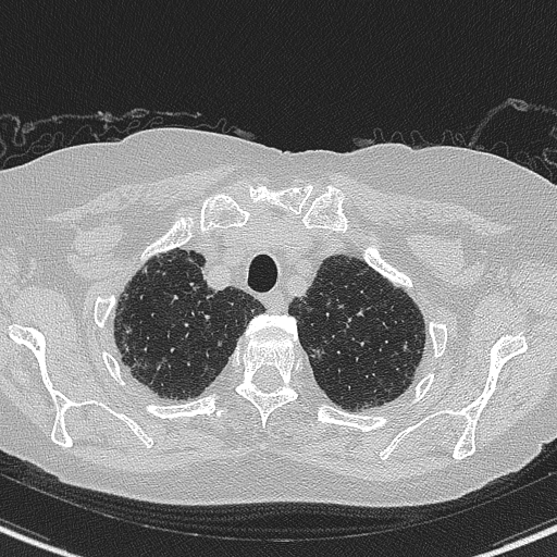Amiodarone-induced pulmonary fibrosis (Radiopaedia 82355-96460 Axial lung window 11).jpg