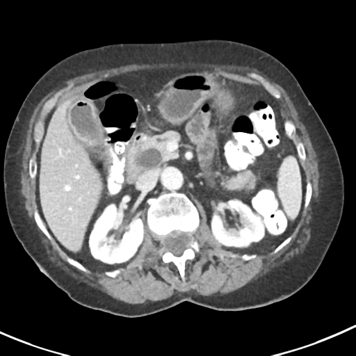 Ampullary adenocarcinoma (Radiopaedia 34013-35237 C 17).png
