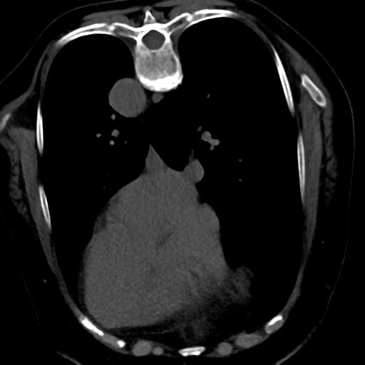 Ampullary adenocarcinoma (Radiopaedia 34013-35241 C 8).png