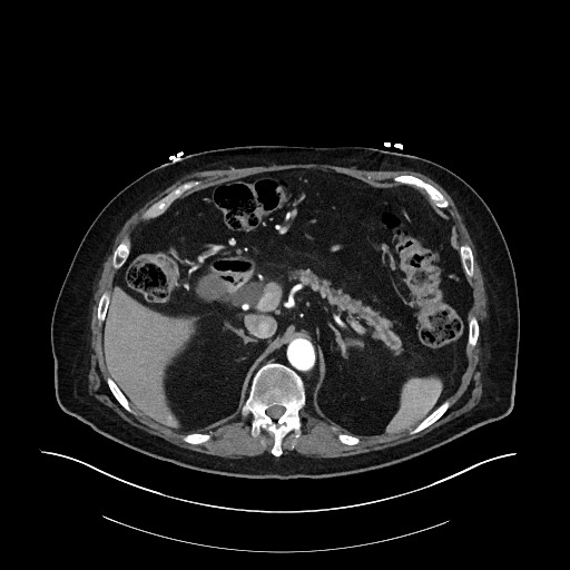 Ampullary adenocarcinoma (Radiopaedia 59373-66734 A 52).jpg