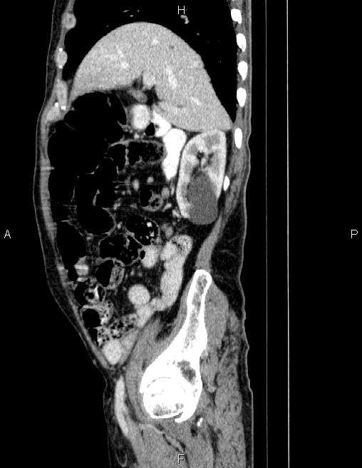 Ampullary adenocarcinoma (Radiopaedia 86093-102032 D 25).jpg
