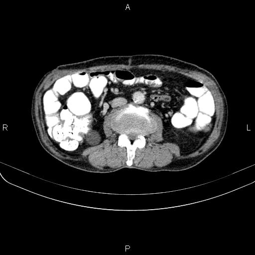 File:Ampullary adenocarcinoma (Radiopaedia 86093-102033 B 73).jpg