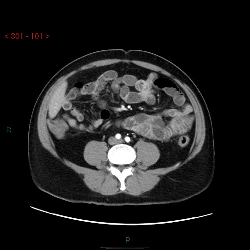 Ampullary carcinoma (Radiopaedia 56396-63056 B 47).jpg