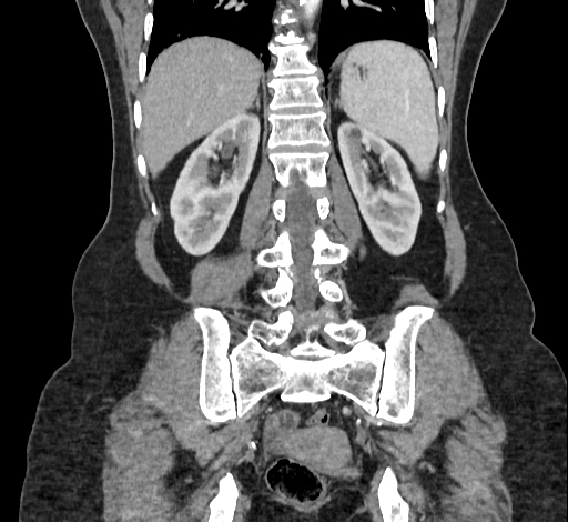 Ampullary tumor (Radiopaedia 60333-67998 B 57).jpg