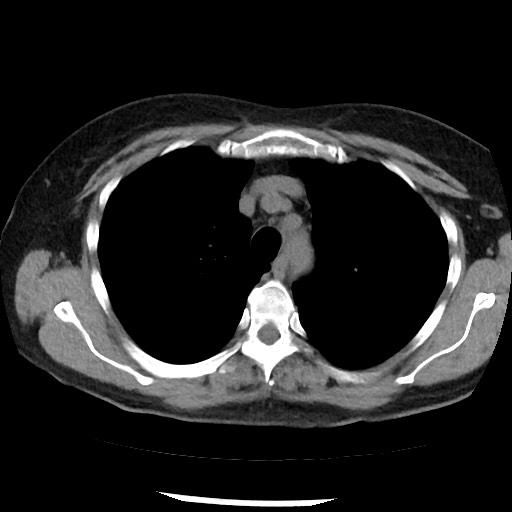 Amyloidosis - bronchial and diffuse nodular pulmonary involvement (Radiopaedia 60156-67744 Axial non-contrast 17).jpg