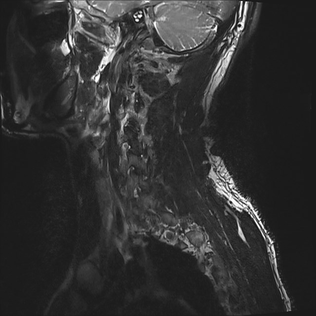 Amyotrophic lateral sclerosis (Radiopaedia 87352-103658 I 64).jpg
