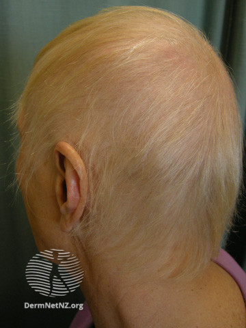 File:Anagen loss during chemotherapy (DermNet NZ hair-nails-sweat-drug-alopecia1).jpg