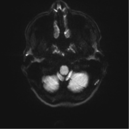Anaplastic astrocytoma IDH mutant (Radiopaedia 50046-55341 Axial DWI 30).png