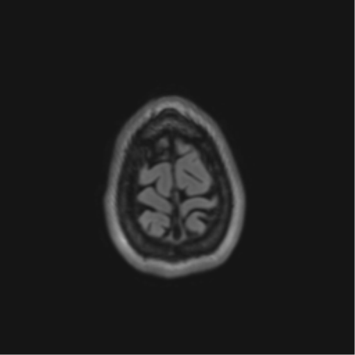 File:Anaplastic astrocytoma IDH mutant (Radiopaedia 50046-55341 Axial FLAIR 45).png