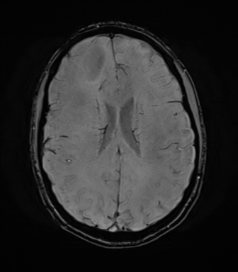 File:Anaplastic astrocytoma IDH mutant (Radiopaedia 50046-55341 Axial SWI 56).png
