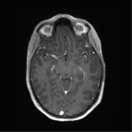 File:Anaplastic astrocytoma IDH mutant (Radiopaedia 50046-55341 Axial T1 C+ 22).png