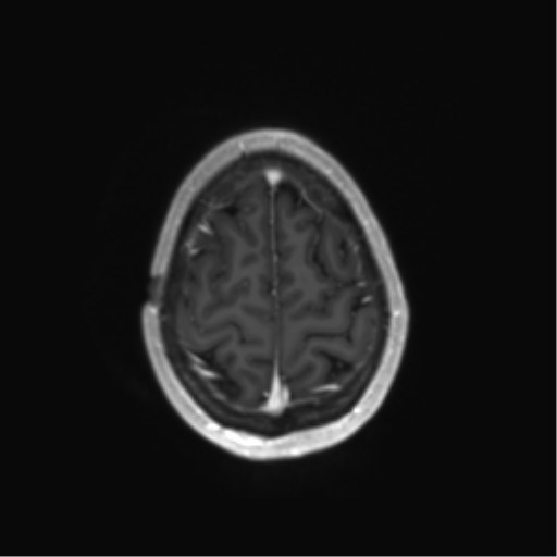 File:Anaplastic astrocytoma IDH mutant (Radiopaedia 50046-55341 Axial T1 C+ 43).png