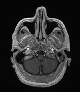 File:Anaplastic astrocytoma IDH wild-type (Radiopaedia 49984-55273 Axial T1 C+ 10).png